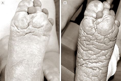 Proteus Syndrome - Life Expectancy, Pictures, Treatment