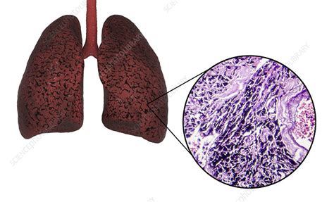 Smoker S Lungs Illustration And Light Micrograph Stock Image F