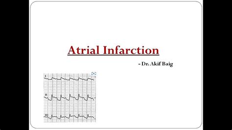 Atrial Infarction Dr Akif Baig YouTube