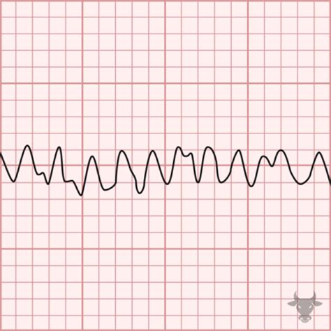 Ventricular Fibrillation | ECG Stampede