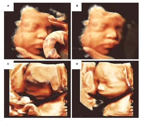 Table 1 From Artificial Intelligence In Obstetric Ultrasound An Update And Future Applications