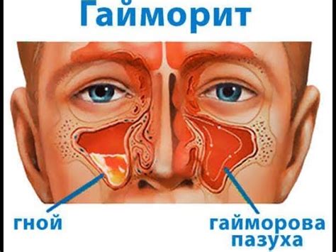 Избавление от насморка и гайморита за 5 минут - YouTube