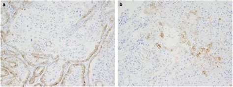 Mismatch Repair Status And PD L1 Expression In Clear Cell Carcinomas Of