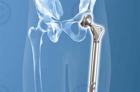 Illustrationen orthopädische Implantate - MedicalGraphics
