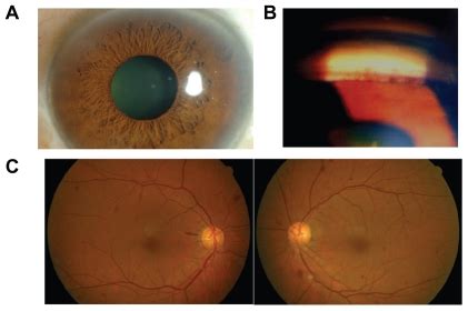 Clinical findings at the initial patient visit. A) Neovascularization ...