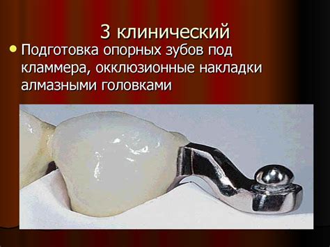 Бюгельные протезы - презентация онлайн