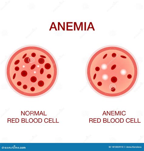 Infographic Image Of Anemia The Difference Of Anemia Amount Of Red