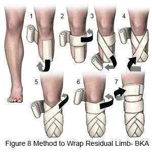 Amputations And Prosthetics Ch Flashcards Quizlet