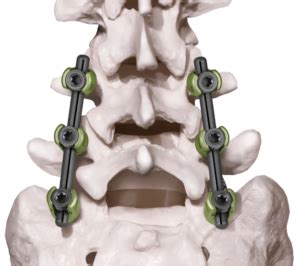 Posterior Lumbar | Globus Medical