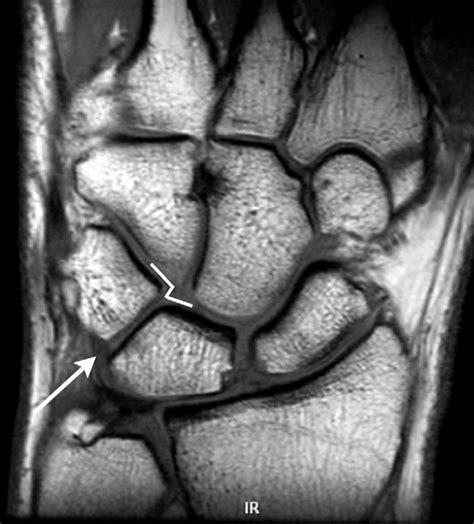 Figure 15 from MRI of wrist ligaments. | Semantic Scholar