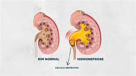 P S Operat Rio Da Cirurgia De C Lculo Renal A Laser