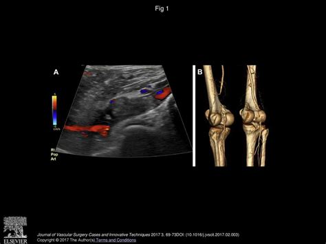 Acute Infection Of Viabahn Stent Graft In The Popliteal Artery Ppt