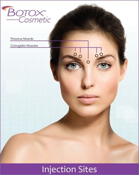 Botox Eyebrow Lift Injection Sites 1000 Images About Botox On