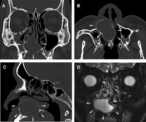 Frontiers Case Report Unilateral Transnasal Endoscopic