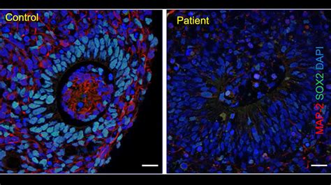 VIDEO Junctional Instability And Network Hyperexcitability In A Focal