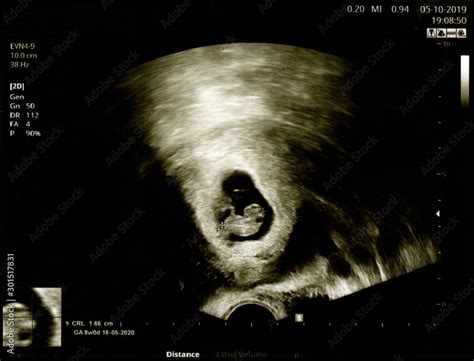 40 Weeks Pregnant Ultrasound