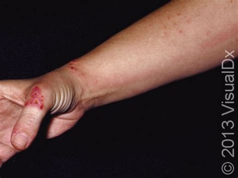 Cellulitis Hand Child