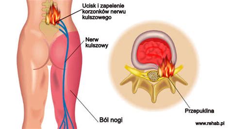 Moszna Leczenie Depresji Zapalenie Korzonk W Nerwowych