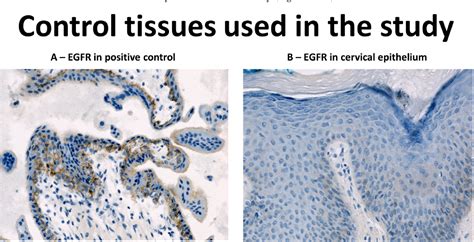 Figure 1 From Diagnostic Utility Of Immunohistochemical Detection Of