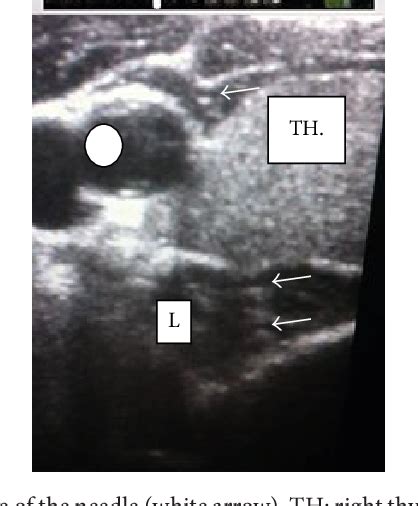 Figure 1 From Ultrasound Guided Stellate Ganglion Block In