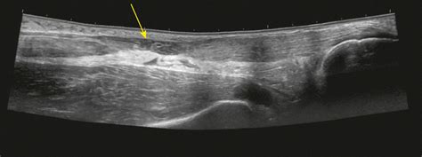 Achilles Tendon Tear Ultrasound