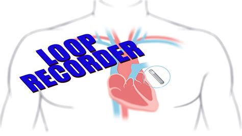 Loop Recorder Monitoring Your Heart Nonsurgical Procedure Youtube