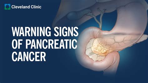 Symptoms And Signs Of Pancreatic Cancer Seena Magowitz Foundation