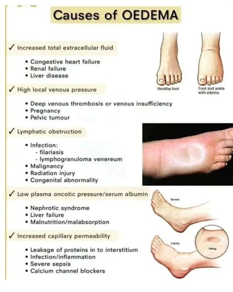 Causes Of Edema MEDizzy