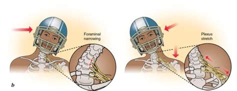 Neurapraxia - Meaning, Treatment, Causes, Symptoms