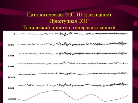Классификация ЭЭГ. «Кливлендская классификация». Основные паттерны ЭЭГ ...