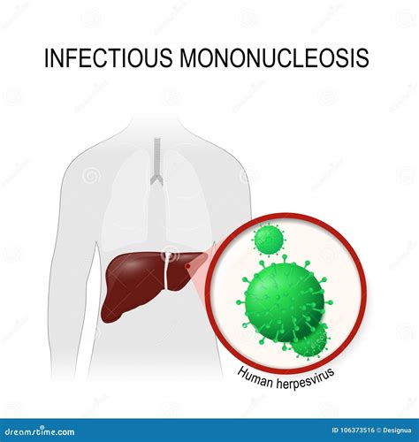 Infectious Mononucleosis Cartoon Vector 55924189