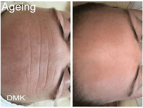 Dmk Muscle Banding Treatment Skinrx Aesthetic Clinic Pty Ltd