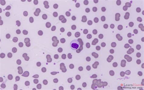 Lymphoplasmacytic Lymphoma Learnhaem Haematology Made Simple