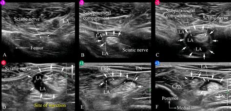 Ultrasound Guided Subparaneural Popliteal Sciatic Nerve Block There Is