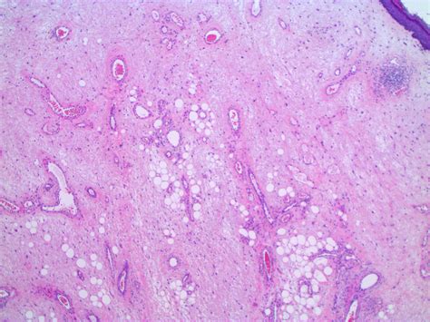 Pathology Outlines Cutaneous Fibroepithelial Polyps