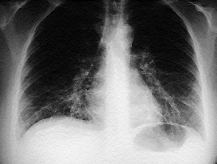 Mycoplasma Pneumoniae Neumon A Medicina Cl Nica Y Quir Rgica