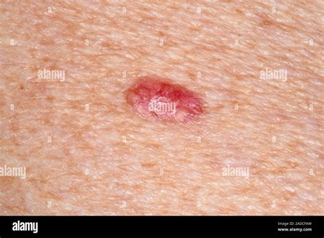 Basal Cell Carcinoma Skin Cancer Close Up Of A Superficial Spreading