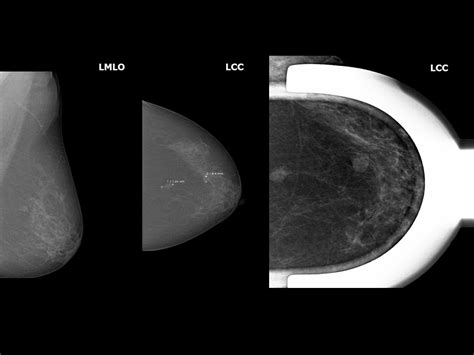 Atlas Of Breast Cancer Early Detection