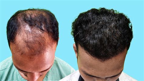 Grade 6 Baldness Hair Transplant Result 4500 Grafts Hair Transplant Youtube