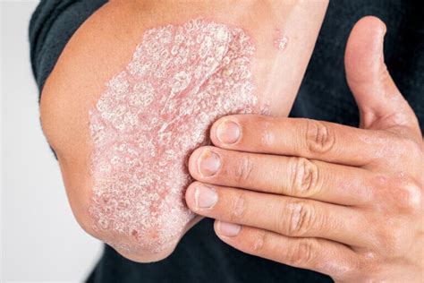 Los S Ntomas De La Psoriasis Muy Salud