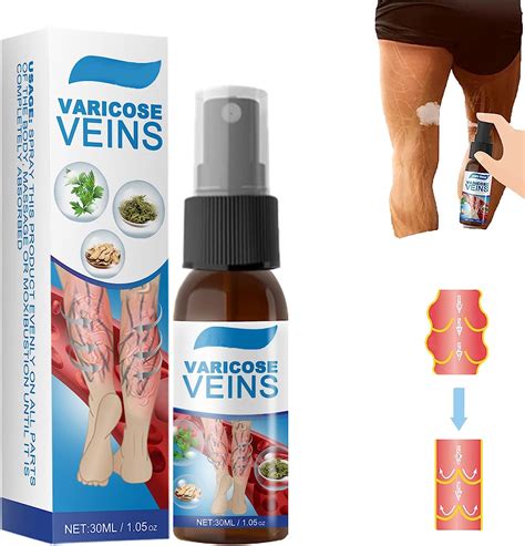 Varicosas En Spray Para Tratamiento De Venas Varicosas Para Piernas