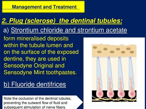 Tooth Hypersensitivity