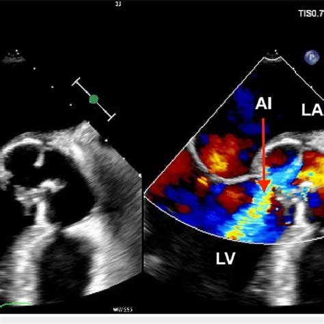 Transesophageal Echocardiographic Findings Of Aortic Root Abscess With Download Scientific