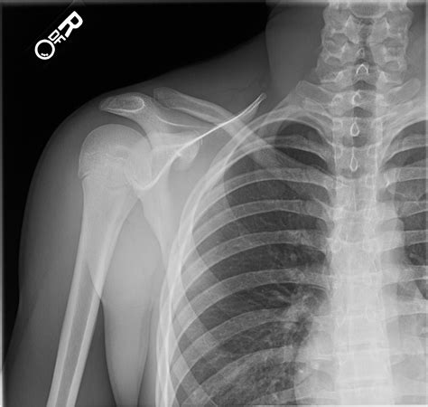 Point Of Care Ultrasound Diagnosis Of Posterior Sternoclavicular Joint