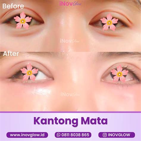 BEFORE AFTER OPERASI KANTUNG MATA INOVGLOW KLINIK SPESIALIS BEDAH