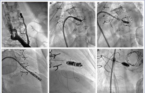 Step By Step Successful Implantation Of The Leadless Pacemaker A