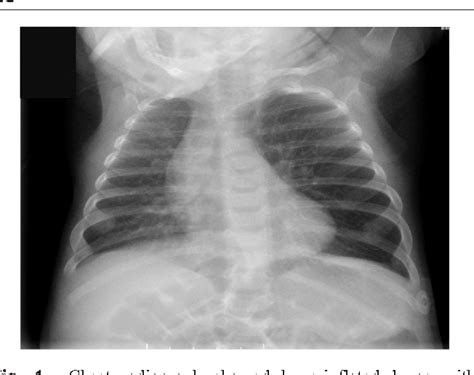 Figure From Congenital Lobar Emphysema And Tension Emphysema