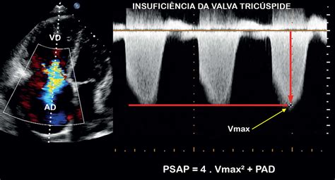 Identifica O Ecocardiogr Fica Da Hipertens O Pulmonar Blog Ecope