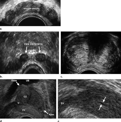 Transrectal Prostate Ultrasound