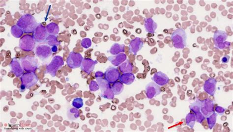 Acute Promyelocytic Leukaemia Apml Learnhaem Haematology Made Simple